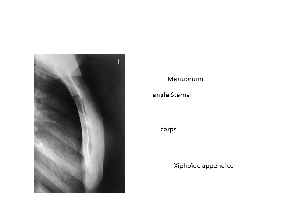 Xiphoïde appendice corps angle Sternal Manubrium