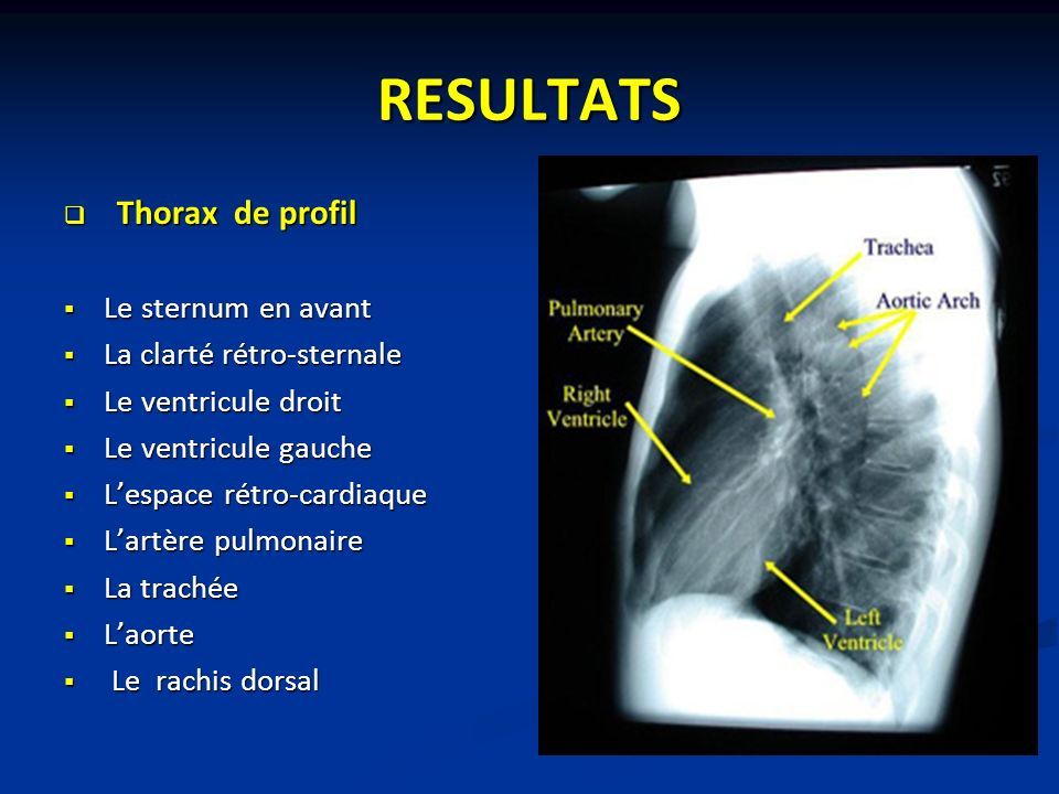 RESULTATS  Thorax de profil  Le sternum en avant  La clarté rétro-sternale  Le ventricule droit  Le ventricule gauche  L’espace rétro-cardiaque  L’artère pulmonaire  La trachée  L’aorte  Le rachis dorsal