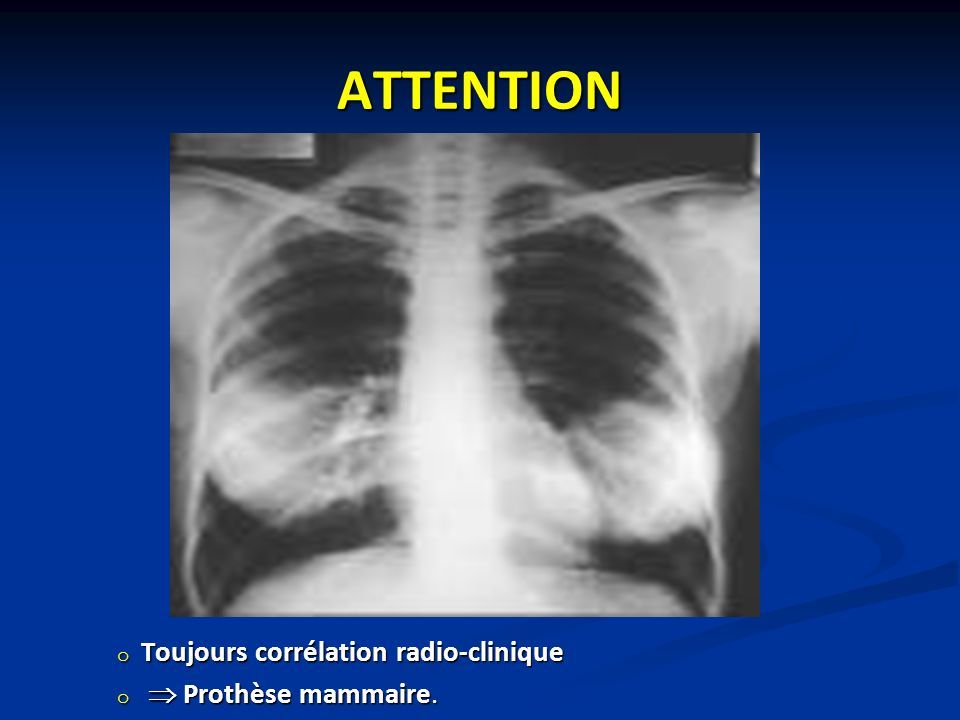 ATTENTION o Toujours corrélation radio-clinique o  Prothèse mammaire.