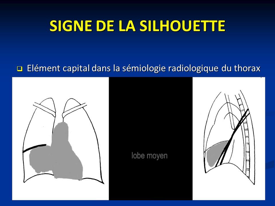SIGNE DE LA SILHOUETTE  Elément capital dans la sémiologie radiologique du thorax