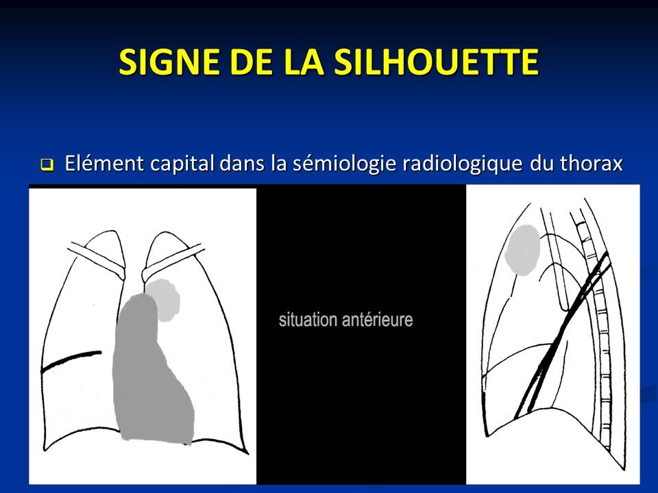 SIGNE DE LA SILHOUETTE  Elément capital dans la sémiologie radiologique du thorax